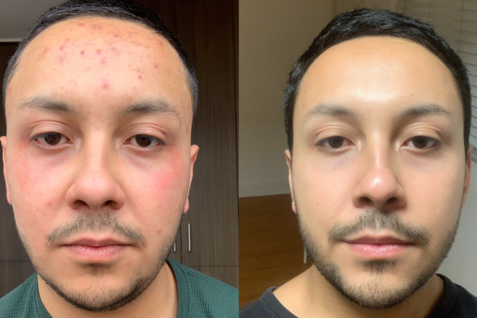 What I Learned in My Desperate Search for a Solution to Severe Acne